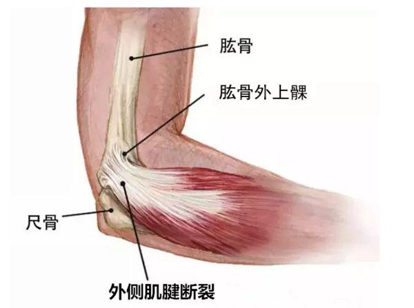 从不打网球的人,为什么也会得网球肘?这就是原因!