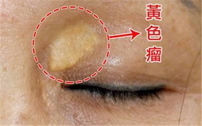 不体检也能看出血脂异常?告诉你三种判断血脂异常的征兆