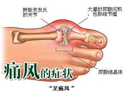 尿酸高与痛风症患者,如何拯救自己?